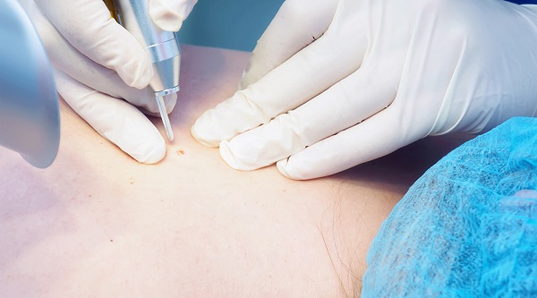 удаление папиллом лазером у мужчин