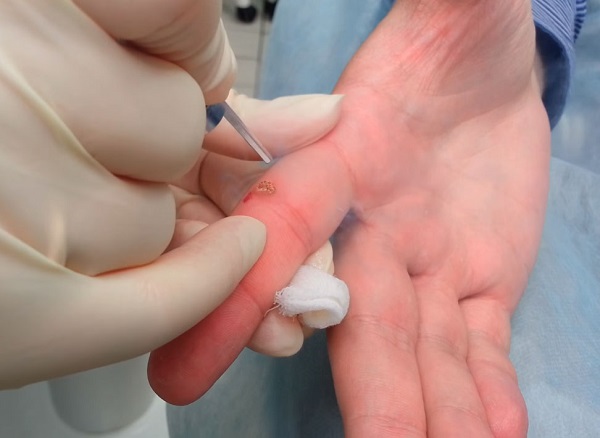 удаление папиллом на руке лазером