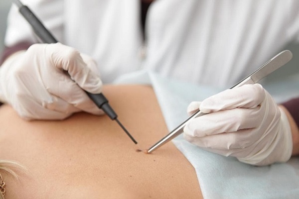 преимущества и недостатки электрокоагуляции