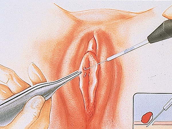 фото: удаление папиллом у женщин