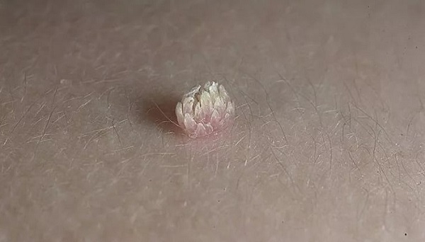 нитевидные папилломы