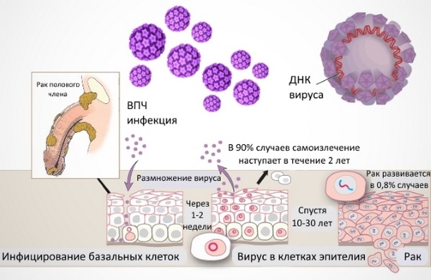 впч 16 и 18 типа у мужчин