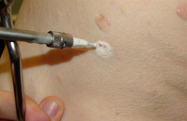удаления папиллом жидким азотом
