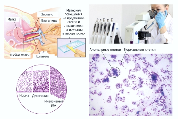 цитологическое исследование мазка на впч