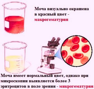 Макрогематурия и микрогематурия