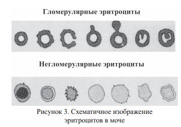 Схематичное изображение эритроцитов в моче