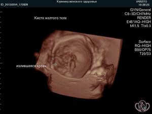 3D-фото кисты желтого тела 3 см в диаметре: определяется излившаяся в кисту кровь 3D-фото кисты желтого тела 3 см в диаметре