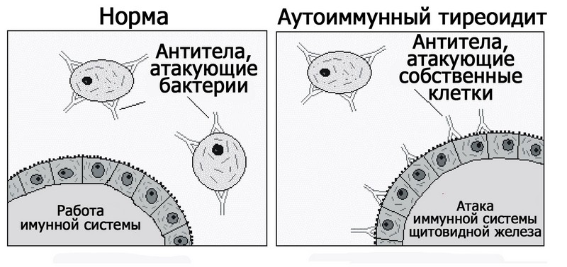 Аутоиммунный тиреоидит