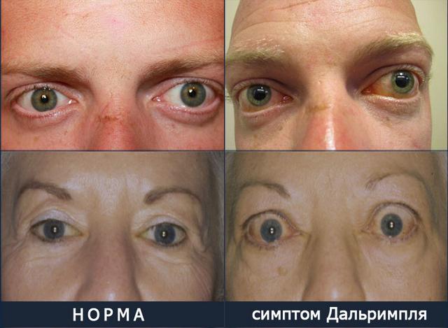 Базедова болезнь симптом Дальримпля