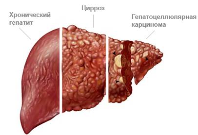 Болезни печени