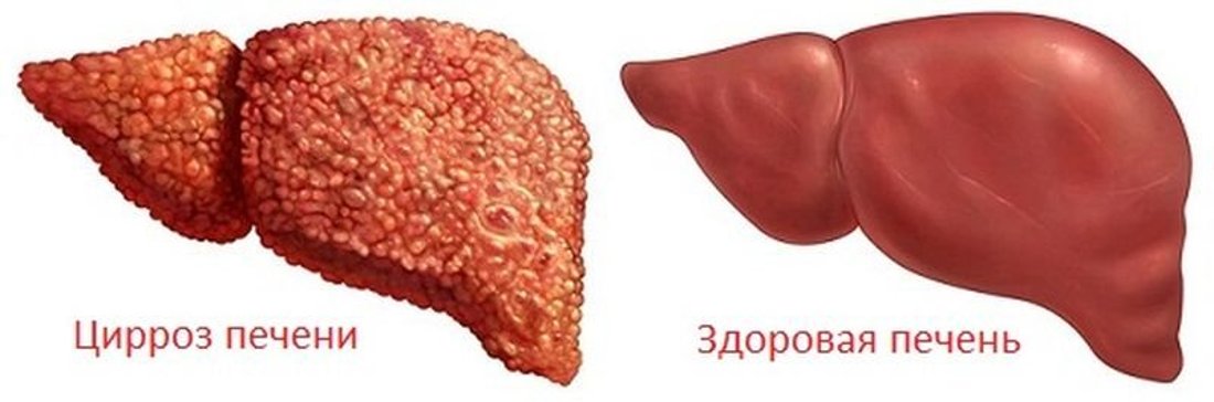 Здоровая и больная циррозом печень