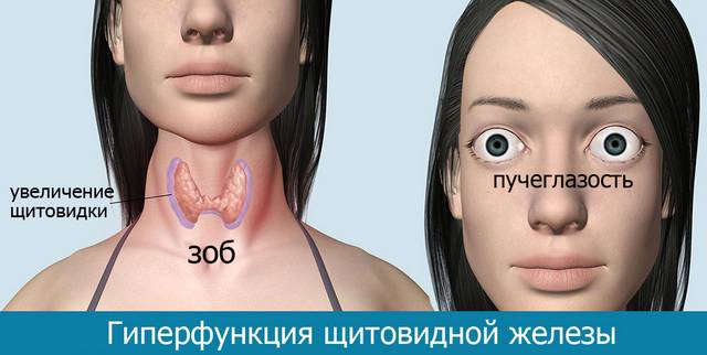 Гиперфункция щитовидной железы