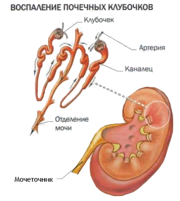 Гломерулонефрит