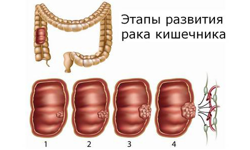 Этапы развития рака кишечника Этапы развития рака кишечника