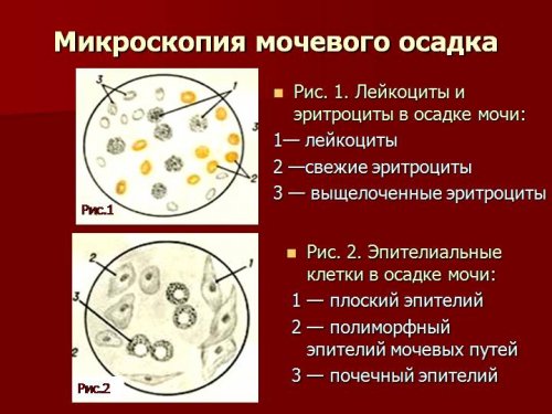 Микроскопия мочевого осадка