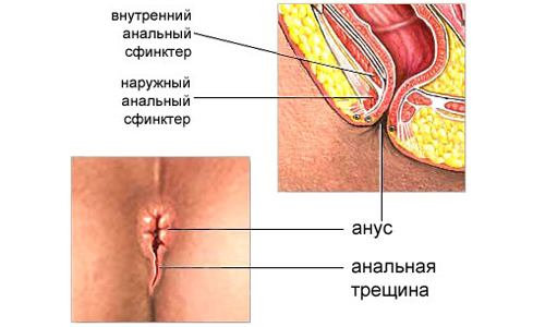 Схема анальной трещины Схема анальной трещины