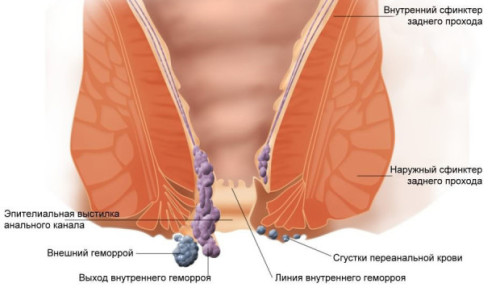 Схема геморроя Схема геморроя