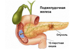 Схема рака поджелудочной железы Схема рака поджелудочной железы