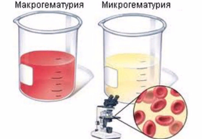 Микро и макрогематурия