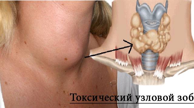 Токсический узловой зоб