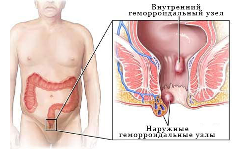 Расположение геморроидальных узлов Расположение геморроидальных узлов