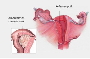 Абляция эндометрия матки