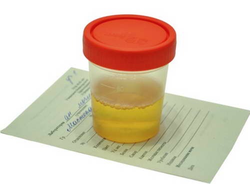 Анализ мочи