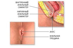 Схема анальной трещины Схема анальной трещины