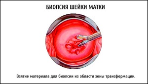 Биопсия шейки матки