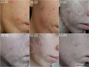 Применение бодяги от черных точек Бодяга от пятен на коже