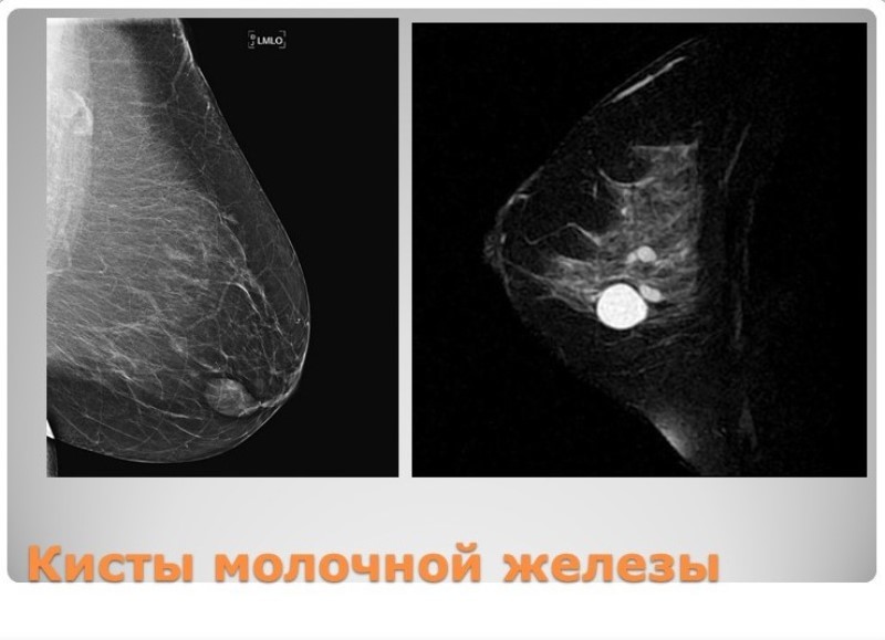 Болезни молочной железы киста