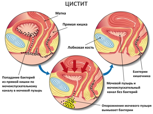 воспаление мочевого пузиря воспаление мочевого пузиря