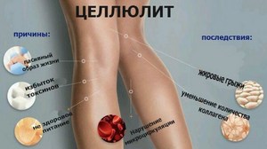 Методы борьбы с целлюлитом Как бороться с целлюлитом