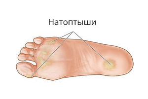 Как бороться с натоптышами