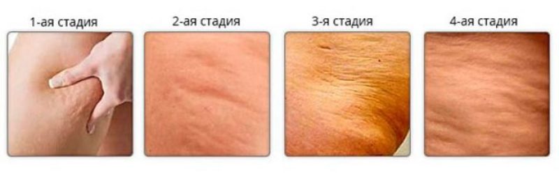 Целлюлит на бедрах