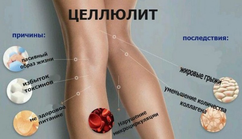 Целлюлит на ногах