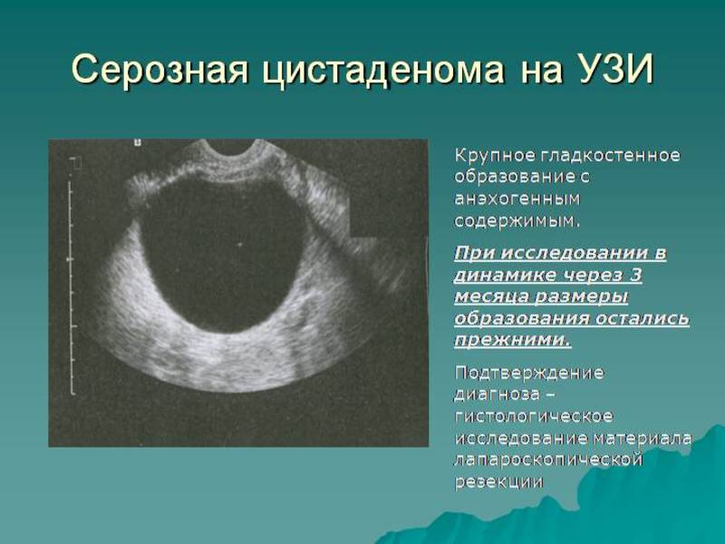 Цистаденома яичника лечение без операции