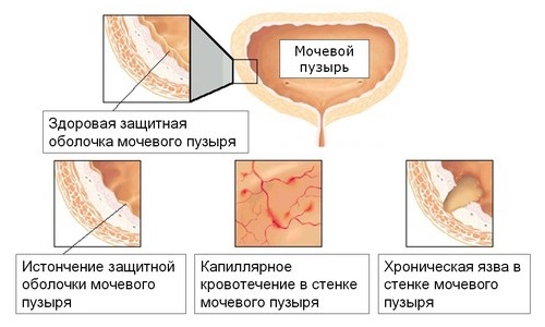Интерстициальный цистит - достаточно опасная форма, при которой воспаление распространяется на слизистую оболочку и мышечный слой