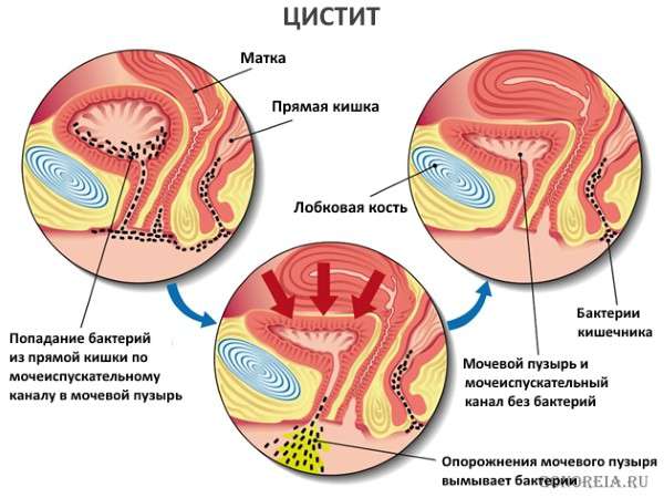 цистит у женщин цистит у женщин