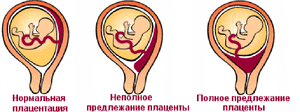 Как избежать низкой плацентации Что делать при низкой плацентации