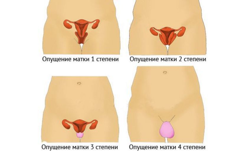 Диагностические мероприятия опущения матки