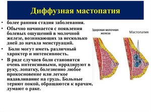 Диффузный фиброаденоматоз молочных желез