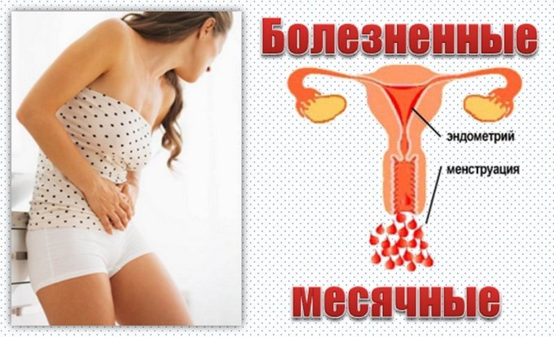 Дисменорея симптомы