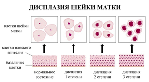 Дисплазия шейки матки 3 степени лечение
