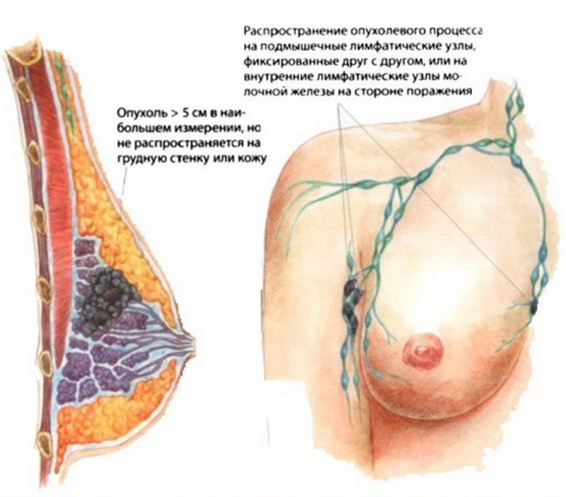 Доброкачественная дисплазия молочной железы