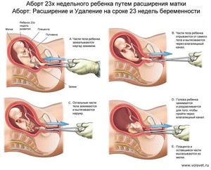 Особенности женского организма Как не допустить выкидыша