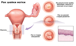 Эрозия шейки матки