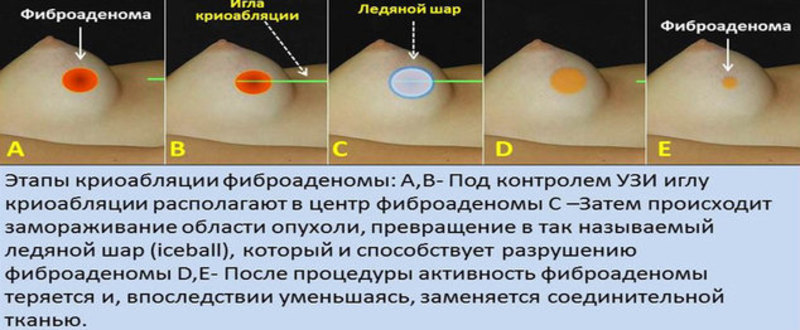 Факторы, повышающие риск возникновения диффузного фиброаденоматоза