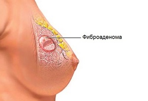 Фиброаденоматоз