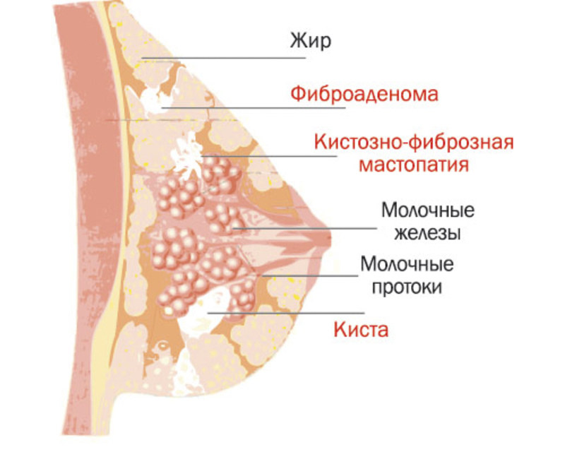 Фиброзная мастопатия